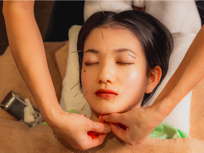 美容鍼の施術イメージ