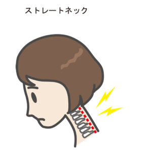 ストレートネック